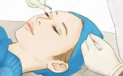 闫迎军医生双眼皮案例