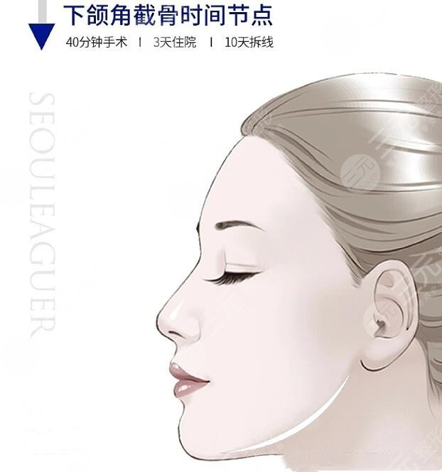 北京黄大勇医生做下颌角磨骨手术案例