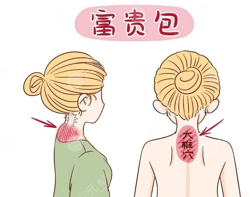 上海九院做富贵包怎么样