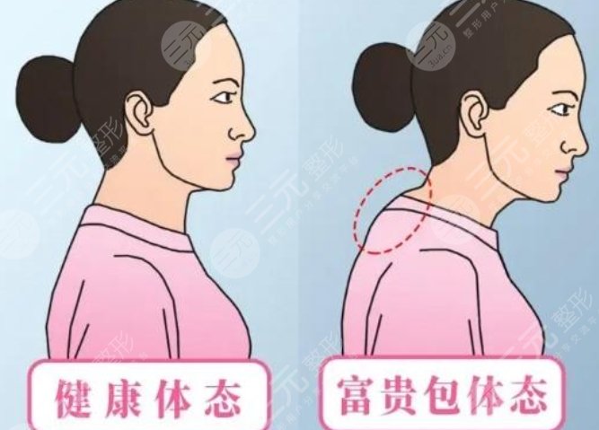 上海九院整复外科做富贵包案例