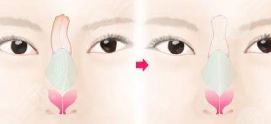 歪鼻矫正