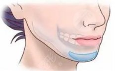 下巴填充哪种方式好？3种材料对比，俊俏下巴轮廓指南！