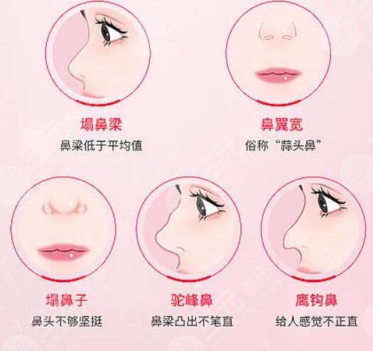 半肋隆鼻手术项目案例体验反馈: