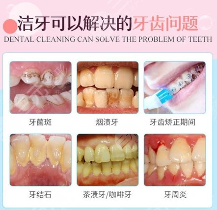 超声波洁牙