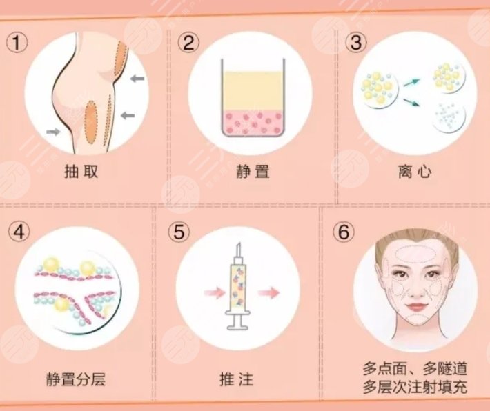 自体脂肪填充面部