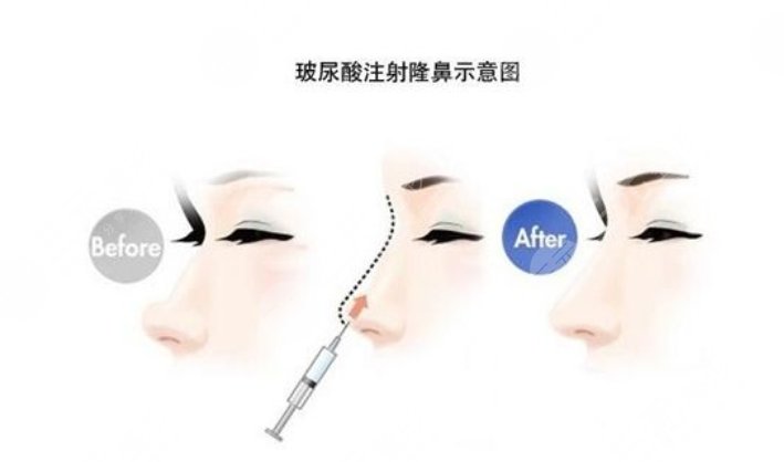 八大处做鼻子找谁价格都一样吗