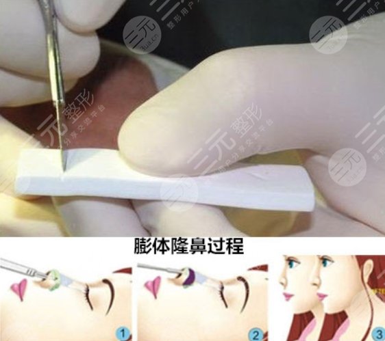 广州艺美做鼻子做得好吗