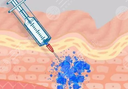 馨妍玻尿酸的优缺点
