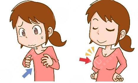 上海自体脂肪隆胸项目案例体验反馈