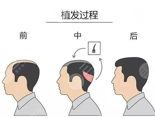 北京304医院植发科普知识分享