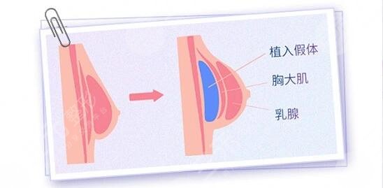 上海同济医院整形科假体隆胸案例分享