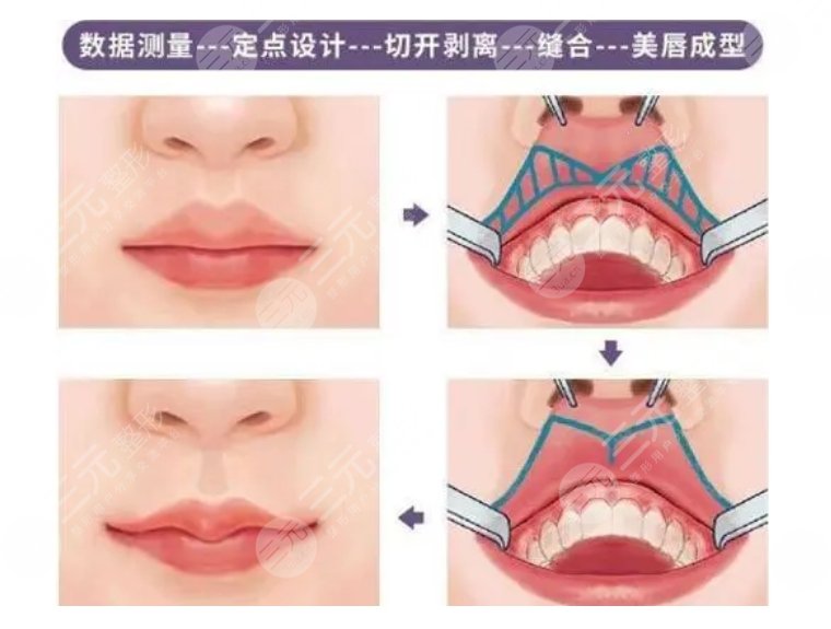 唇厚改薄