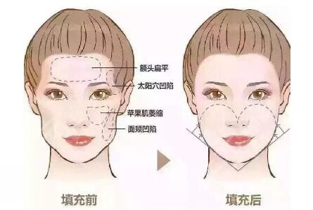 成都做脂肪填充刘培医生怎么样?