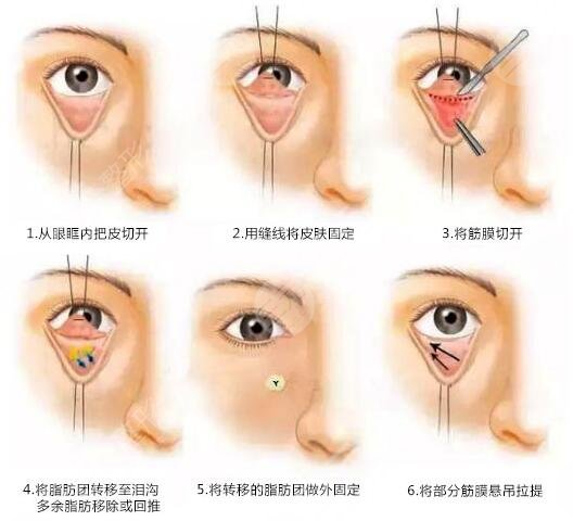 上海周美兰医生双眼皮、去眼袋眼部综合整形案例分享