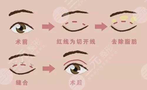 上海周美兰医生双眼皮、去眼袋眼部综合整形案例分享