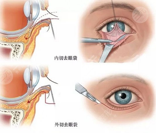 外切去眼袋