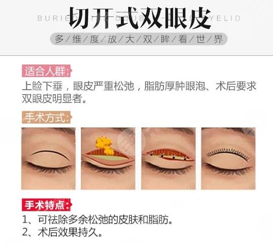 黄良飞双眼皮修复科普分享