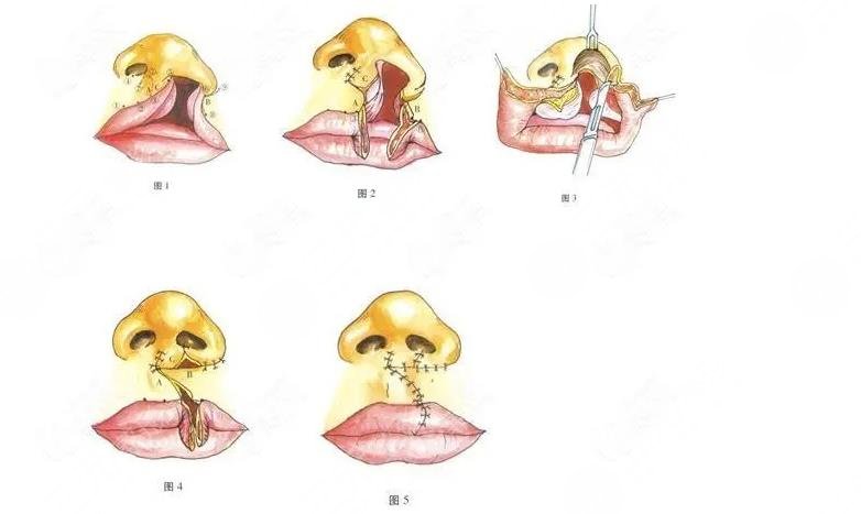 范锴医生唇裂鼻技术怎么样?