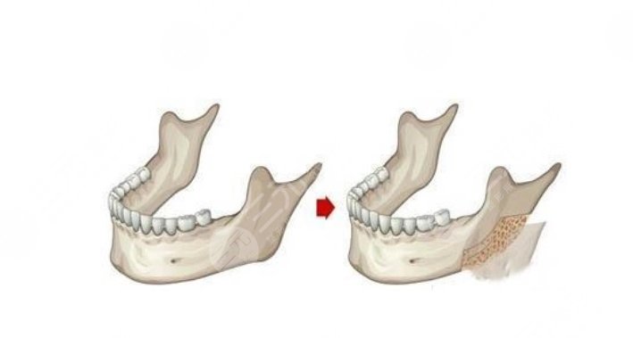 上海华美医院磨骨