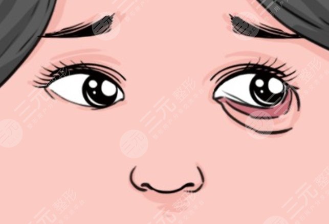 下眼睑外翻修复