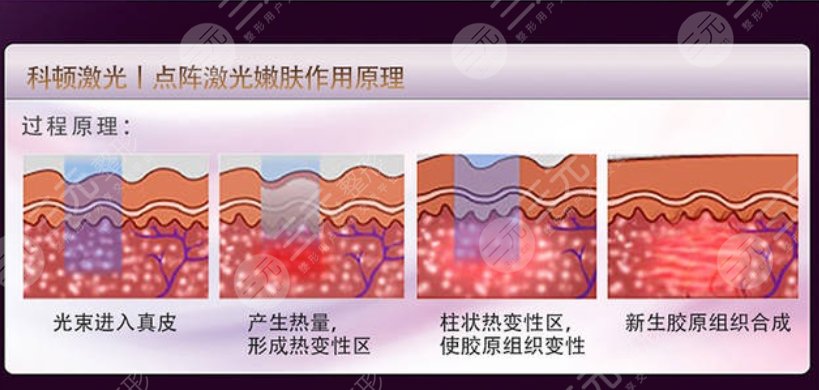 点阵激光