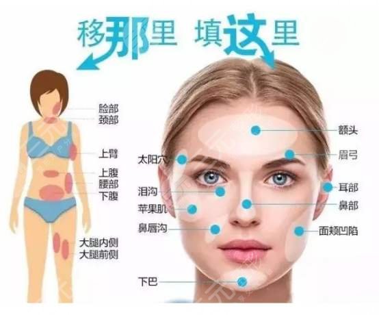 上海长海医院全脸脂肪填充案例