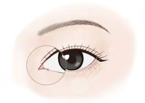 陆军总医院美容中心开眼角科普知识分享