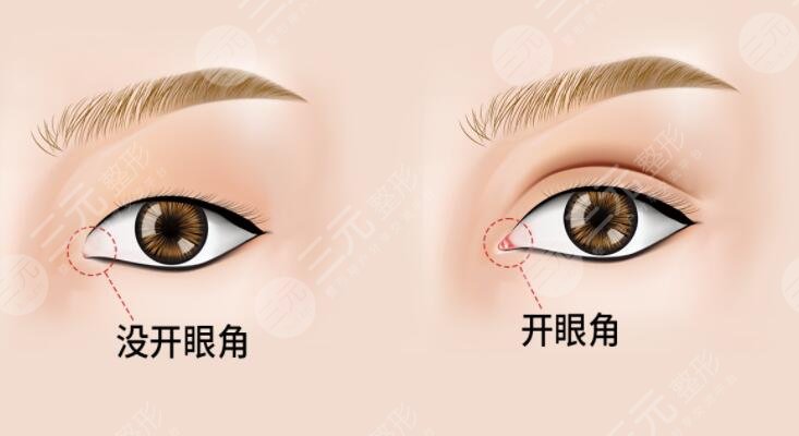 陆军总医院美容中心开眼角科普知识分享