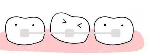 牙齿矫正