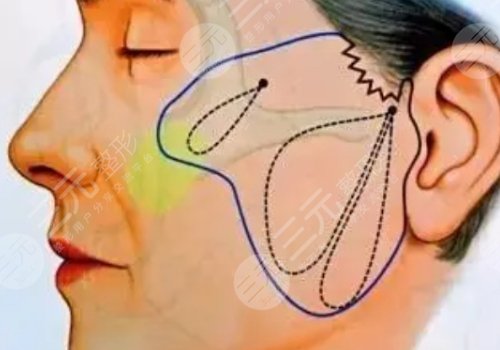 微创小切口拉皮恢复期多长时间