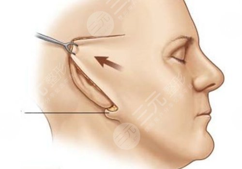 微创小切口拉皮恢复期多长时间