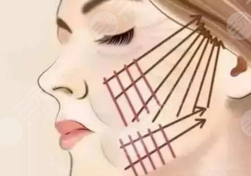 微创小切口拉皮恢复期多长时间