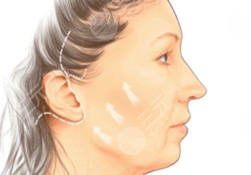 微创小切口拉皮恢复期多长时间