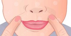 怎样去除鼻唇沟？3个小妙招分享，医美助你搞定“颜值沟壑”！