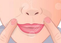 鼻唇沟太深怎么办？玻尿酸注射、脂肪填充可以帮你改良！
