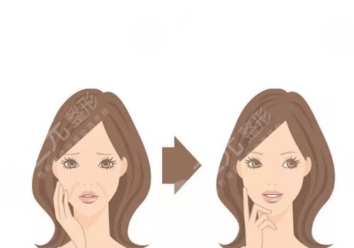 鼻唇沟太深怎么办