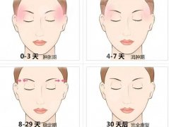 自体脂肪填充颞部怎么样?丰太阳穴优点、费用参考,术前盲点扫雷! 自体脂肪填充颞部怎么样?丰太阳穴优点、费用参考,术前盲点扫雷!