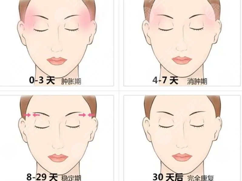 填充颞部