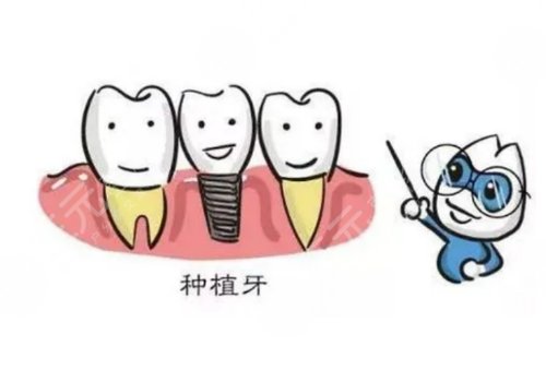 种植牙的过程步骤