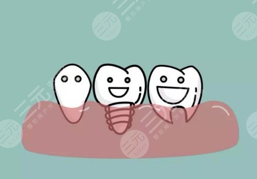 种植牙的过程步骤