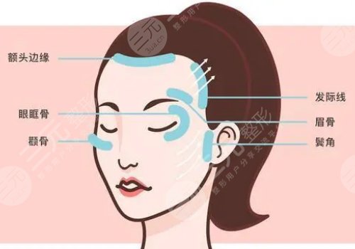 小拉皮手术可以维持多久