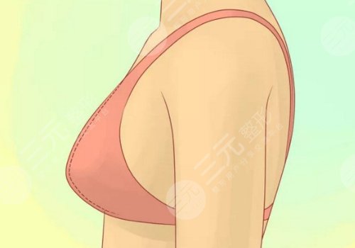 隆胸假体取出亲身经历