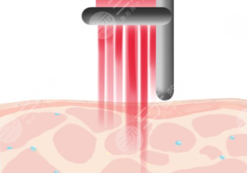 南京艺星医疗美容医院祛痣多少钱