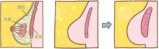 美国麦格假体隆胸会不会痛?