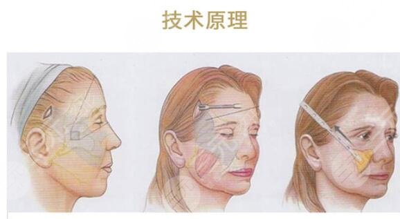 高亚东医生拉皮手术真人案例分享