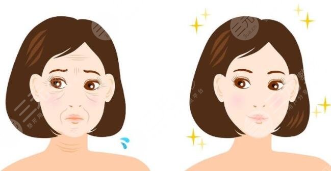 高亚东医生拉皮手术真人案例分享