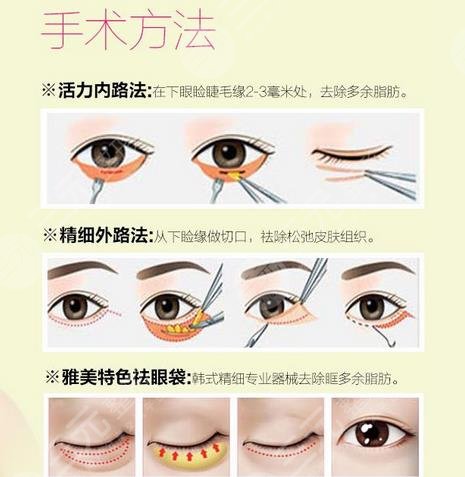 深圳阳光医院做眼袋大概要多少钱