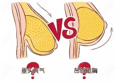 杭州徐法伟医生缩胸案例