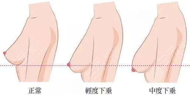 乳房下垂松弛