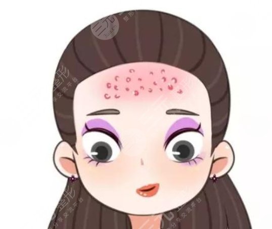 额头长痘痘